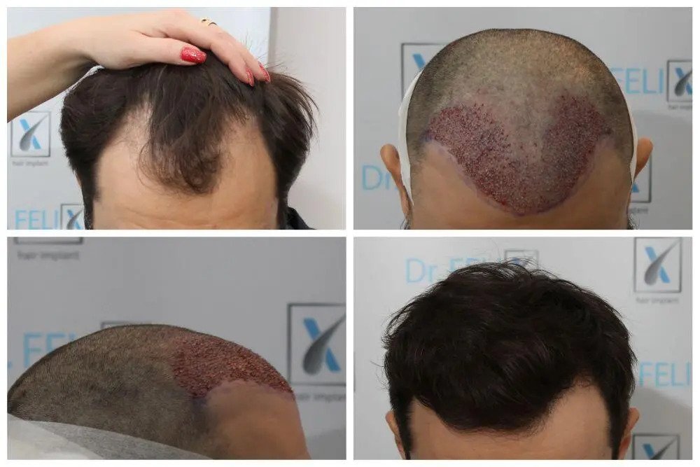implant par dr felix hair implant
